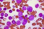 Free Stock Photo: Microscopic view of blast crisis of chronic myelogenous leukemia