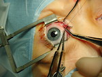 Free Stock Photo: Closeup of eye surgery